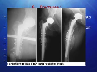 6 . Fractures :

• Fractures of femur, acetabulum, or pubic ramus
  may occur during and after THR.
• Femoral fractures are by far the most common.
  Management :
• Conservative with traction
• Additional plate and screws
• Plate fixation
• Revision arthroplasty with long stem
• Custom made prosthesis.
 