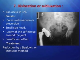 7. Dislocation or subluxation :
• Can occur in 3 %
  Causes :
• Excess retroversion or
  ateversion
• Small size head,
• Laxity of the soft tissue
  around the joint.
• Insufficient offset.
  Treatment :
Reduction by : Bigelows or
  Stimsons method
 