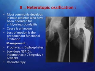 8 . Heterotopic ossification :
• Most commonly develops
  in male patients who have
  been operated for
  anklyosing spondylitis
• Cause is unknown
• Loss of motion is the
  predominant functional
  limitation
  Management :
• Prophylaxis: Diphosphates
• Low dose NSAIDs,
  indomethacin 75mg/day x
  6 weeks
• Radiotherapy
 