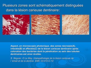 Plusieurs zones sont schématiquement distinguéesPlusieurs zones sont schématiquement distinguées
dans la lésion carieuse dentinairedans la lésion carieuse dentinaire::
A B C
Aspect, en microscopie photonique, des zones nécrosée(A),Aspect, en microscopie photonique, des zones nécrosée(A),
infectée(B) et affectée(C) de la lésion carieuse dentinaire aprèsinfectée(B) et affectée(C) de la lésion carieuse dentinaire après
coloration des bactéries dont la pénétration au sein des tubulescoloration des bactéries dont la pénétration au sein des tubules
dentinaires est ainsi révélée.dentinaires est ainsi révélée.
S. Séguier, O Le May. Histopathologie de la lésion carieuse deS. Séguier, O Le May. Histopathologie de la lésion carieuse de
l ’émail et de la dentine. EMC 23-010-C-10l ’émail et de la dentine. EMC 23-010-C-10
 