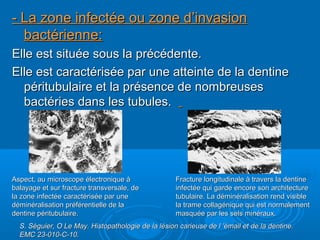 - La zone infectée ou zone d’invasion- La zone infectée ou zone d’invasion
bactérienne:bactérienne:
Elle est située sous la précédente.Elle est située sous la précédente.
Elle est caractérisée par une atteinte de la dentineElle est caractérisée par une atteinte de la dentine
péritubulaire et la présence de nombreusespéritubulaire et la présence de nombreuses
bactéries dans les tubules.bactéries dans les tubules.
Aspect, au microscope électronique àAspect, au microscope électronique à
balayage et sur fracture transversale, debalayage et sur fracture transversale, de
la zone infectée caractérisée par unela zone infectée caractérisée par une
déminéralisation préférentielle de ladéminéralisation préférentielle de la
dentine péritubulaire.dentine péritubulaire.
Fracture longitudinale à travers la dentineFracture longitudinale à travers la dentine
infectée qui garde encore son architectureinfectée qui garde encore son architecture
tubulaire. La déminéralisation rend visibletubulaire. La déminéralisation rend visible
la trame collagénique qui est normalementla trame collagénique qui est normalement
masquée par les sels minéraux.masquée par les sels minéraux.
S. Séguier, O Le May. Histopathologie de la lésion carieuse de l ’émail et de la dentine.S. Séguier, O Le May. Histopathologie de la lésion carieuse de l ’émail et de la dentine.
EMC 23-010-C-10.EMC 23-010-C-10.
 