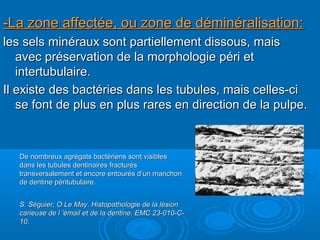 -La zone affectée, ou zone de déminéralisation:-La zone affectée, ou zone de déminéralisation:
les sels minéraux sont partiellement dissous, maisles sels minéraux sont partiellement dissous, mais
avec préservation de la morphologie péri etavec préservation de la morphologie péri et
intertubulaire.intertubulaire.
Il existe des bactéries dans les tubules, mais celles-ciIl existe des bactéries dans les tubules, mais celles-ci
se font de plus en plus rares en direction de la pulpe.se font de plus en plus rares en direction de la pulpe.
De nombreux agrégats bactériens sont visiblesDe nombreux agrégats bactériens sont visibles
dans les tubules dentinaires fracturésdans les tubules dentinaires fracturés
transversalement et encore entourés d’un manchontransversalement et encore entourés d’un manchon
de dentine péritubulaire.de dentine péritubulaire.
S. Séguier, O Le May. Histopathologie de la lésionS. Séguier, O Le May. Histopathologie de la lésion
carieuse de l ’émail et de la dentine. EMC 23-010-C-carieuse de l ’émail et de la dentine. EMC 23-010-C-
10.10.
 