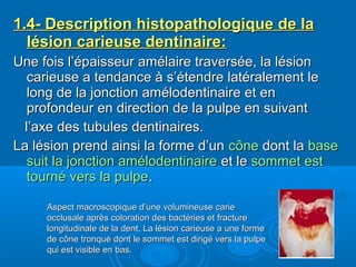 1.4- Description histopathologique de la1.4- Description histopathologique de la
lésion carieuse dentinaire:lésion carieuse dentinaire:
Une fois l’épaisseur amélaire traversée, la lésionUne fois l’épaisseur amélaire traversée, la lésion
carieuse a tendance à s’étendre latéralement lecarieuse a tendance à s’étendre latéralement le
long de la jonction amélodentinaire et enlong de la jonction amélodentinaire et en
profondeur en direction de la pulpe en suivantprofondeur en direction de la pulpe en suivant
l’axe des tubules dentinaires.l’axe des tubules dentinaires.
La lésion prend ainsi la forme d’unLa lésion prend ainsi la forme d’un ccôônene dont ladont la basebase
suit la jonction amélodentinairesuit la jonction amélodentinaire et leet le sommet estsommet est
tourné vers la pulpetourné vers la pulpe..
Aspect macroscopique d’une volumineuse carieAspect macroscopique d’une volumineuse carie
occlusale après coloration des bactéries et fractureocclusale après coloration des bactéries et fracture
longitudinale de la dent. La lésion carieuse a une formelongitudinale de la dent. La lésion carieuse a une forme
de cde côône tronqué dont le sommet est dirigé vers la pulpene tronqué dont le sommet est dirigé vers la pulpe
qui est visible en bas.qui est visible en bas.
 