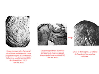 Coupe transversale d’un canal
distal d’une molaire subit à une
pulpotomie après escarrification,
la lumière canalair est comblée
de cément (Lutz 1923)
Ref: J.C.HESS
Coupe longitudinale au niveau
de la zone du foramen apical,
4mois après l’intervention (Pilz)
Ref: J.C.HESS
Un an et demi après , la totalité
de l’extrémité du canal est
oblitérée
 