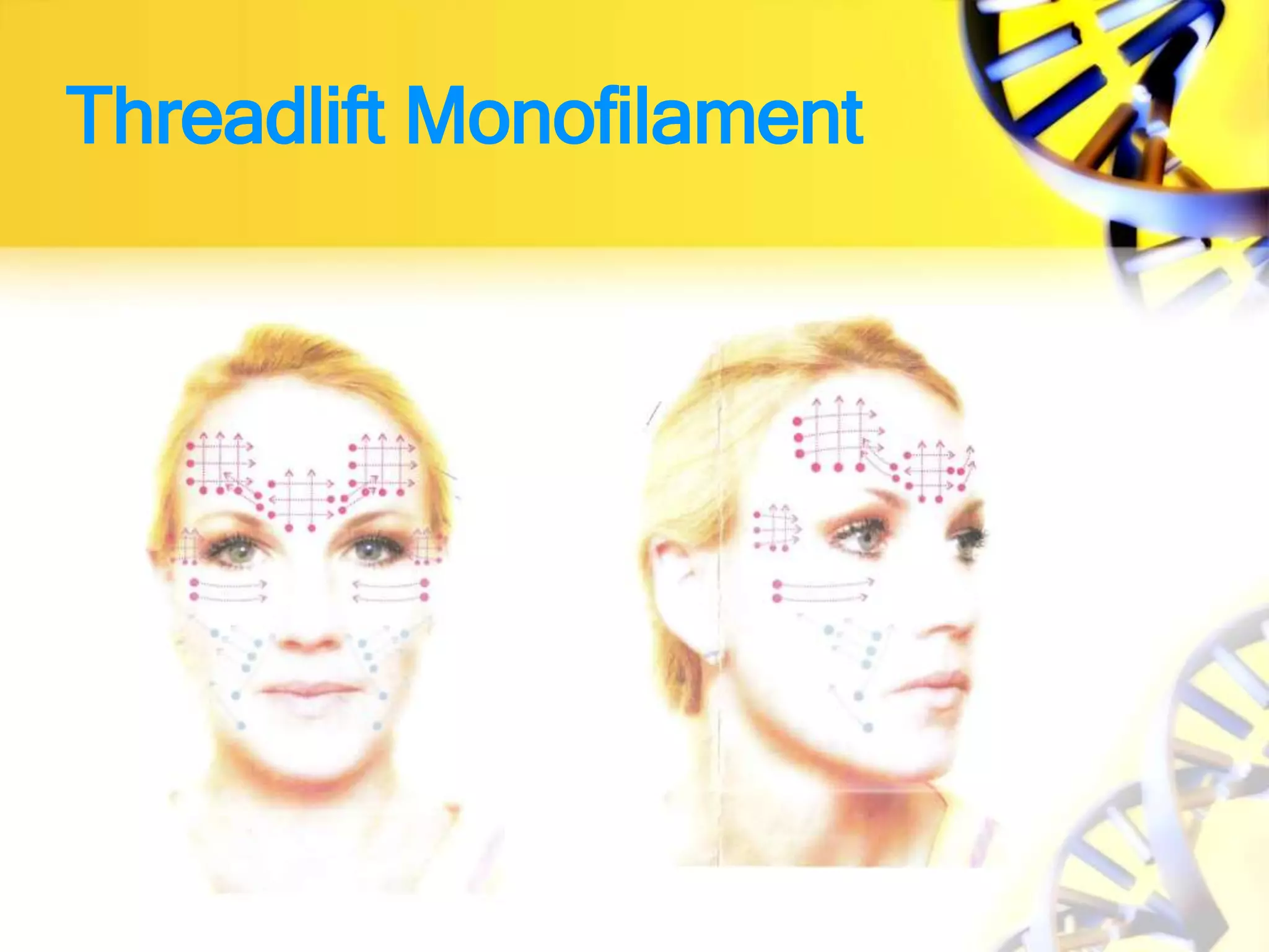 Threadlift Monofilament
 