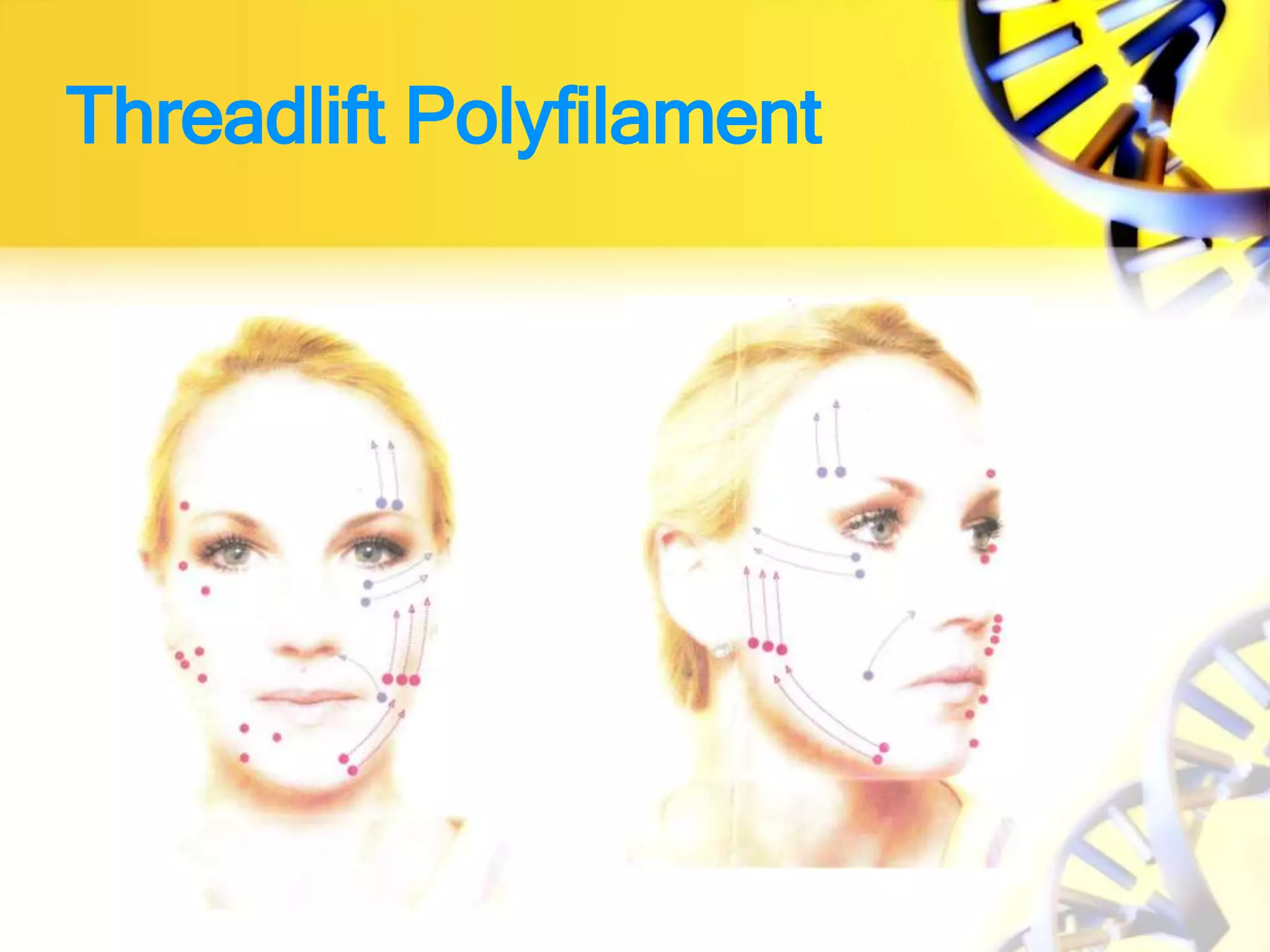 Threadlift Polyfilament
 