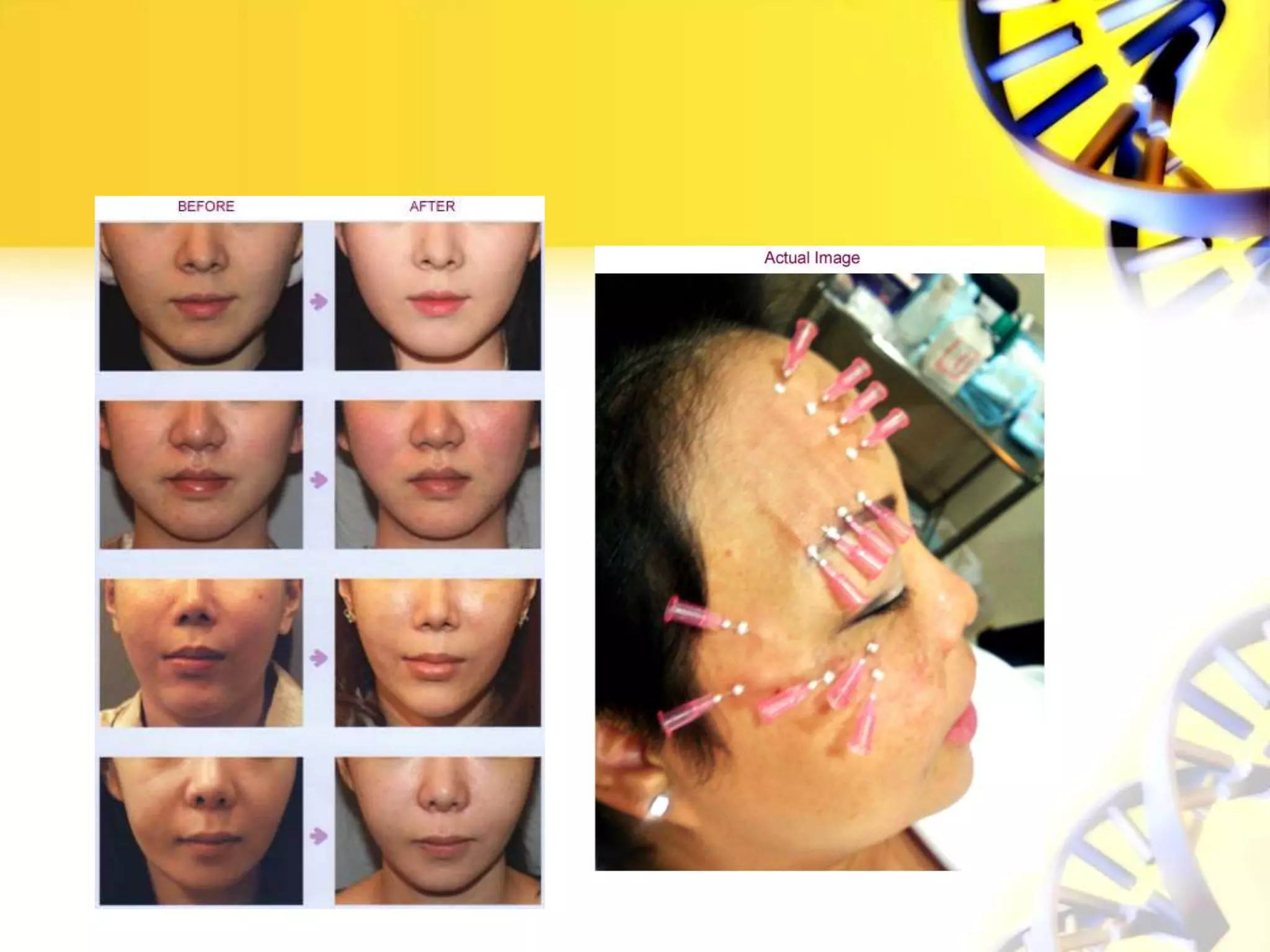 Threadlift pp anti aging