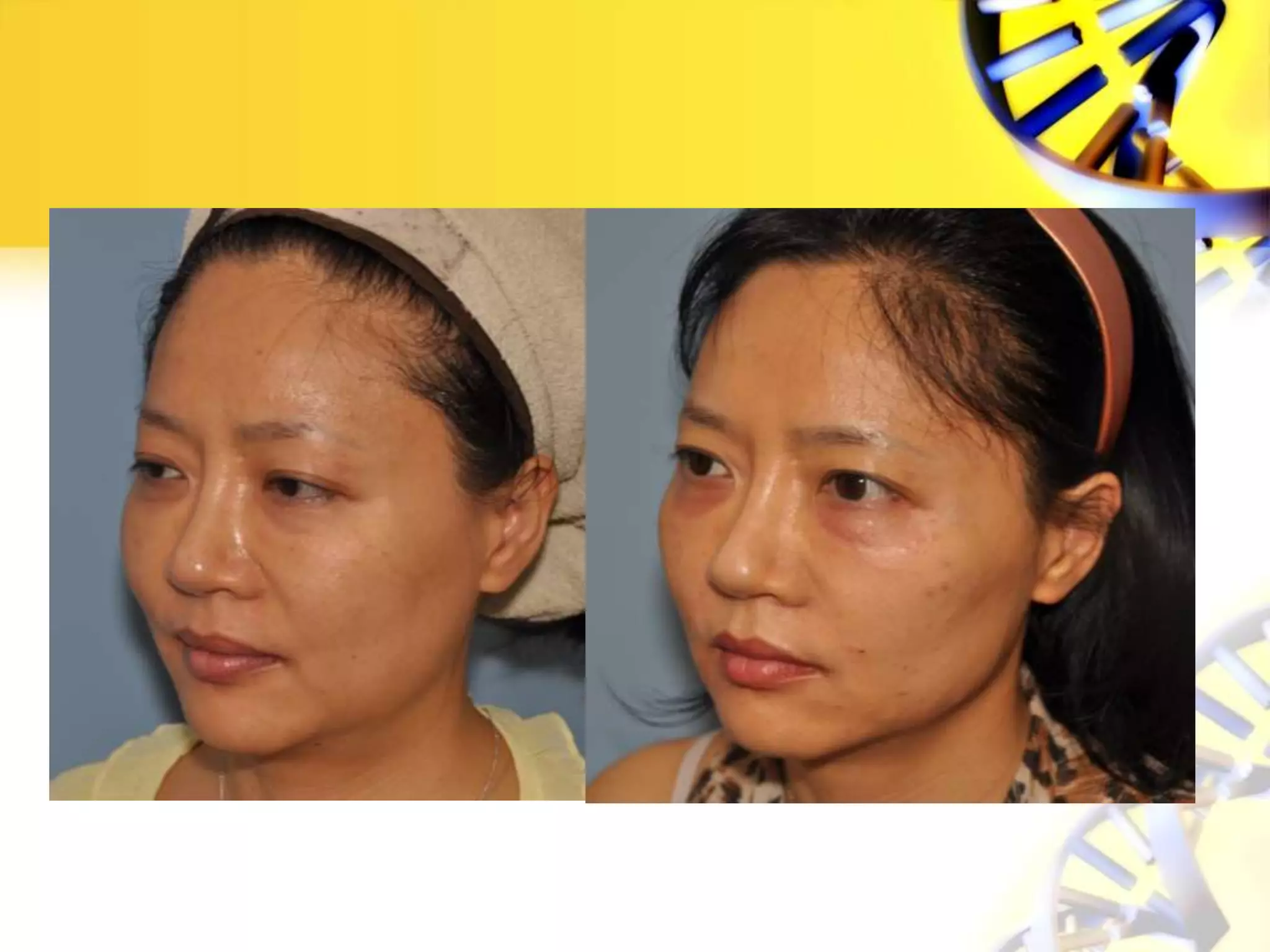 Threadlift pp anti aging