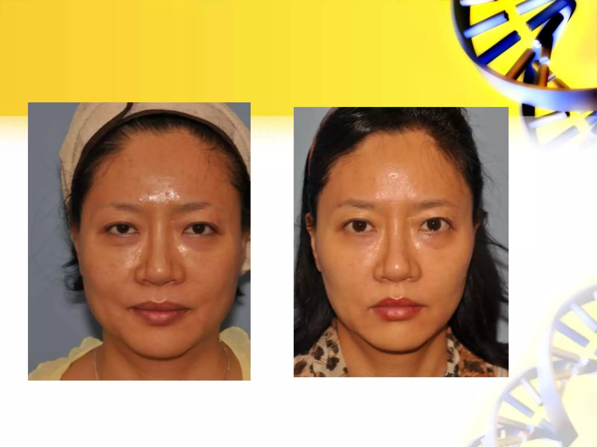 Threadlift pp anti aging