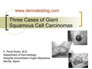 Three Cases of Giant Squamous Cell Carcinomas  F. Peral Rubio, M.D. Department of Dermatology Hospital Universitario Virgen Macarena Seville, Spain www.dermatoblog.com  