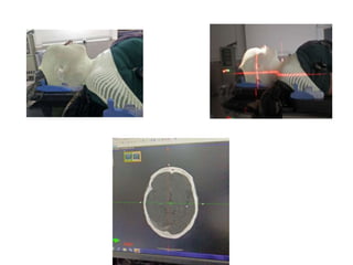 Three dimensional conformal radiation therapy | PPTX