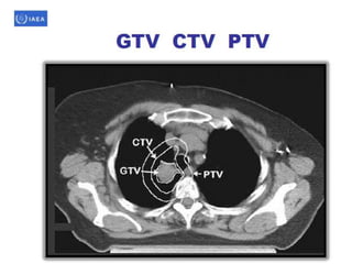 Normal Ctv Rad Three dimensional conformal radiation therapy | PPTX