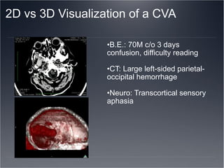 2D vs 3D Visualization of a CVA  B.E.: 70M c/o 3 days confusion, difficulty reading CT: Large left-sided parietal-occipital hemorrhage Neuro: Transcortical sensory aphasia 