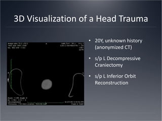 3D Visualization of a Head Trauma 20Y, unknown history (anonymized CT) s/p L Decompressive Craniectomy s/p L Inferior Orbit Reconstruction 