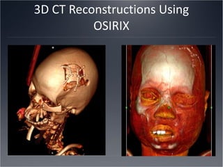 3D CT Reconstructions Using OSIRIX 