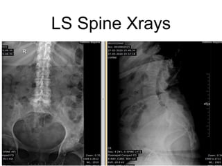 LS Spine Xrays
 