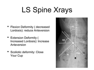 LS Spine Xrays
• Flexion Deformity ( decreased
Lordosis): reduce Anteversion
• Extension Deformity (
Increased Lordosis): Increase
Anteversion
• Scoliotic deformity: Close
Your Cup
 