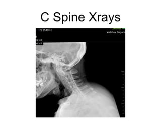 C Spine Xrays
 