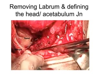 Removing Labrum & defining
the head/ acetabulum Jn
Head
labrum
 