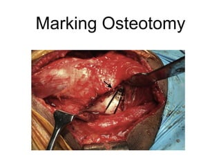 Marking Osteotomy
 