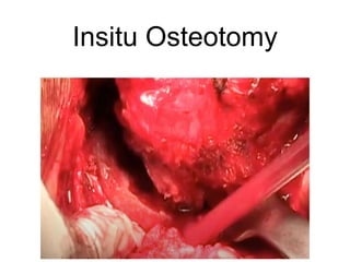Insitu Osteotomy
 