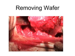 Removing Wafer
 