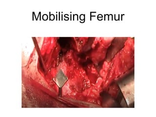 Mobilising Femur
 