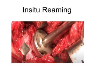 Insitu Reaming
 