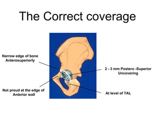 The Correct coverage
At level of TAL
2 - 3 mm Postero -Superior
Uncovering
Narrow edge of bone
Anterosuperiorly
Not proud at the edge of
Anterior wall
 