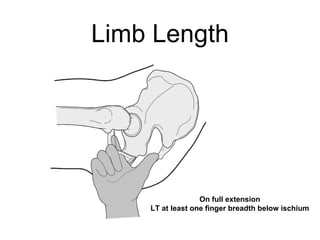 Limb Length
On full extension
LT at least one finger breadth below ischium
 