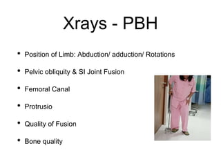 Xrays - PBH
• Position of Limb: Abduction/ adduction/ Rotations
• Pelvic obliquity & SI Joint Fusion
• Femoral Canal
• Protrusio
• Quality of Fusion
• Bone quality
 