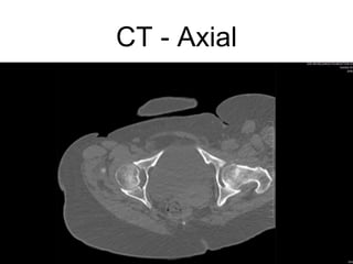 CT - Axial
 