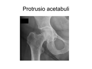 Protrusio acetabuli
 