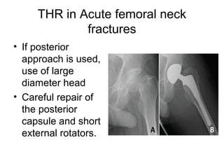 THR in Acute femoral neck
fractures
• If posterior
approach is used,
use of large
diameter head
• Careful repair of
the posterior
capsule and short
external rotators.
 
