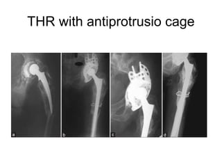 THR with antiprotrusio cage
 