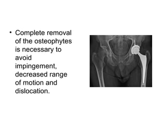 • Complete removal
of the osteophytes
is necessary to
avoid
impingement,
decreased range
of motion and
dislocation.
 