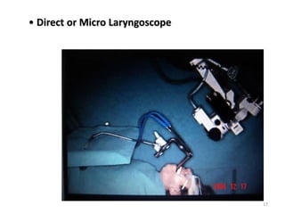 • Direct or Micro Laryngoscope
17
 
