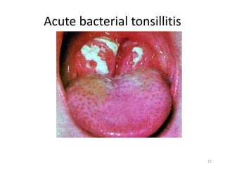 Acute bacterial tonsillitis
22
 
