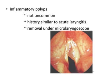 • Inflammatory polyps
~ not uncommon
~ history similar to acute laryngitis
~ removal under microlaryngoscope
41
 