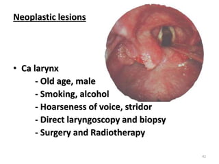 Neoplastic lesions
• Ca larynx
- Old age, male
- Smoking, alcohol
- Hoarseness of voice, stridor
- Direct laryngoscopy and biopsy
- Surgery and Radiotherapy
42
 