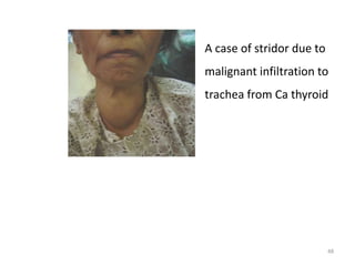 A case of stridor due to
malignant infiltration to
trachea from Ca thyroid
48
 
