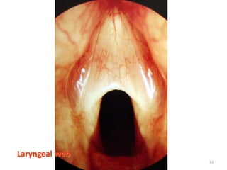 Laryngeal web
53
 