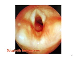 Subglottis hemangioma
54
 