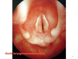 Acute laryngotracheobronchitis
55
 