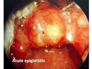 Acute epiglottitis
56
 