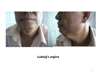 Ludwig’s angina
57
 
