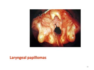Laryngeal papillomas
58
 