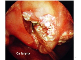 Ca larynx
59
 