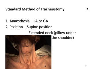Standard Method of Tracheostomy
1. Anaesthesia – LA or GA
2. Position – Supine position
Extended neck (pillow under
the shoulder)
1
2
64
 