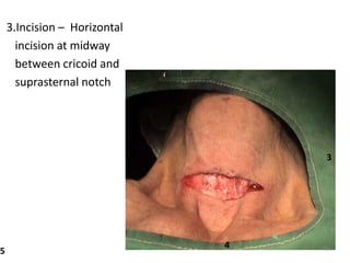 3.Incision – Horizontal
incision at midway
between cricoid and
suprasternal notch
3
4
5 65
 
